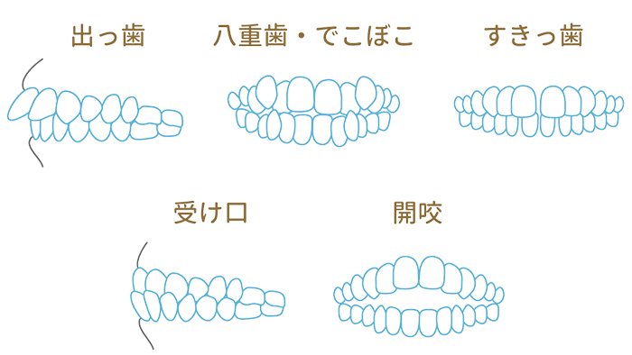 インビザラインの費用、安い - 沖縄県那覇市 矯正歯科相談室